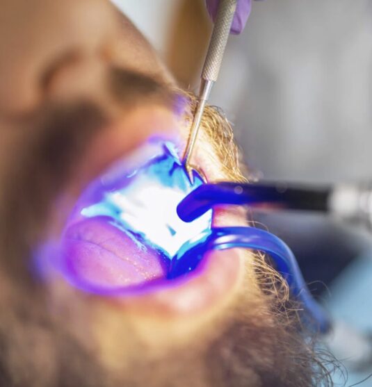 Patient receiving a tooth-colored filling in Towson MD at Smithberger DDS